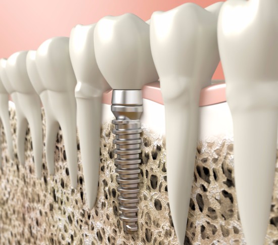 Dental Implants, Surrey Dentist